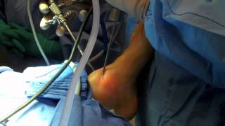 Ankle Arthroscopy [upl. by Ainet291]