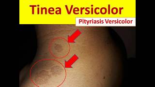 Tinea Versicolor in Young People  Pityriasis Versicolor [upl. by Antebi772]