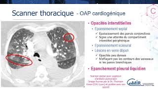 3 15 4 œdème aigu pulmonaire cardiogénique  Scanner [upl. by Anelagna388]