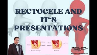 RECTOCELE VARIOUS SURGICAL OPTIONS FOR THIS TROUBLESOME DISEASE [upl. by Rogozen]