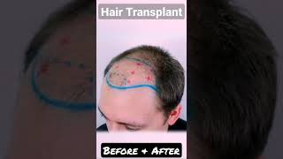 Hair Transplant Follow for more shorts [upl. by Leia149]