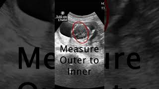 How to measure a Biparietal Diameter POCUS Ultrasound emergencymedicine obgyn [upl. by Laoj235]