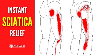 How to Instantly Fix Sciatica Pain [upl. by Anirpas349]