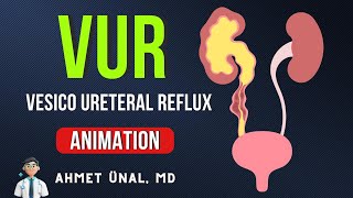 🎬 VUR Vesico Ureteral Reflux CLASSIFICATION amp ANIMATION [upl. by Ojyma]