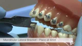 American Orthodontics Alexander LTS Brackets  Bracket Placement Video [upl. by Mureil]