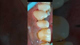 Scaling and Air Polishing using Prophymate teeth teethcleaning teethwhitening [upl. by Arotak]