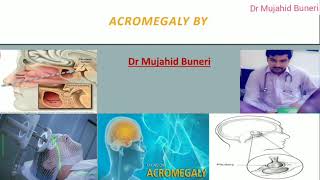 Achieve Mastery In Acromegaly Within 10 Minutes  Dr M B [upl. by Nolahs]