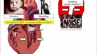 12DaysinMarch Valvular Heart Disease 8 HCM and Questions for the USMLE Step One Exam [upl. by Eidnim669]