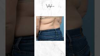 CoolSculpting Before amp After Results [upl. by Miculek284]