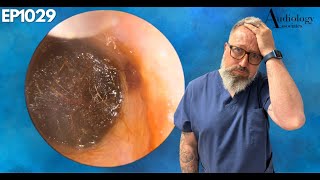 INSANE DEEP EAR WAX PLUG REMOVAL  EP1029 [upl. by Nema513]