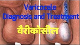 VARICOCELE  Symptoms Causes and Treatment in HINDI Dr Santosh Agrawal [upl. by Dnomder]