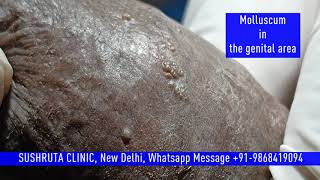 Molluscum in Genital area [upl. by Strong]