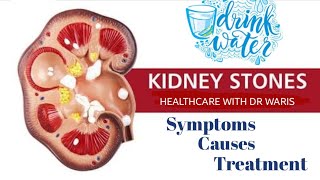 Kidney stones — Symptoms treatment and prevention [upl. by Alleuol]