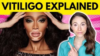 Vitiligo WHY YOU HAVE IT amp WHAT TO AVOID [upl. by Mohn]