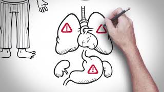 Comprendre linsuffisance cardiaque [upl. by Alahs]