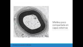 Neuropatías Asociadas a Gammapatías Monoclonales [upl. by Franciscka856]