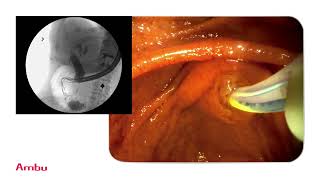 Dr Sam Serouya Performs amp Narrates a Sphincterotomy and Stent Placement Using the aScope™ Duodeno [upl. by Noswal]