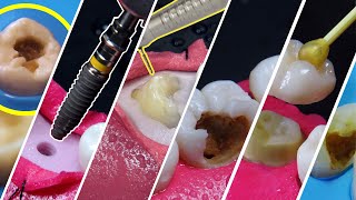 12 MEJORES vídeos de tratamientos DENTALES en 4K  Vídeo colección [upl. by Anoynek249]