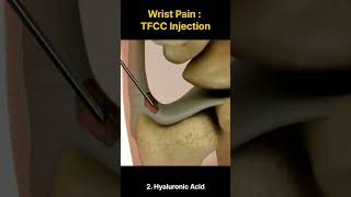 Unlocking Relief TFCC Injections for Wrist Pain [upl. by Jareen]