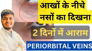 आँखों के नीचे गहरे हरे रंग की नसें दिखाई देने का क्या कारण है ॥ PERIORBITAL VEINS UNDER EYES [upl. by Dorrahs]