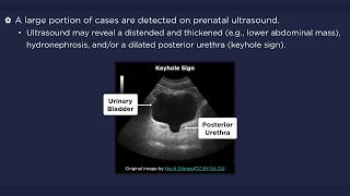 Posterior Urethral Valves [upl. by Nothgiel662]