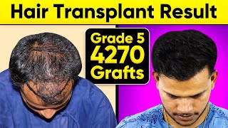 Best Hair Transplant in Agra 4270 Grafts Norwood Grade 5 at Saraswat Hospital India [upl. by Porte306]