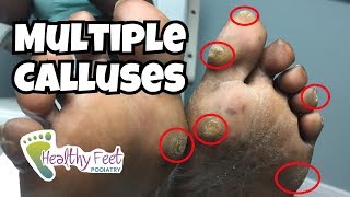 Multiple Calluses on Feet [upl. by Man736]