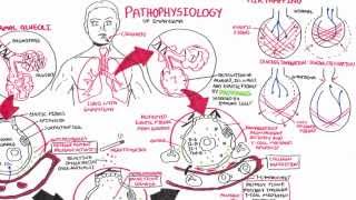 Emphysema  Pathophysiology COPD [upl. by Thorny]