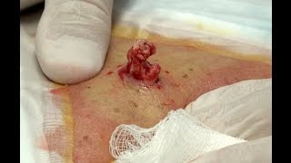 Abscessed Cyst  Cobras MidBack [upl. by Barty129]