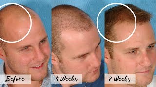 CURE FOR BALDNESS  Stop the Receding Hairline  Natural Hair Regrow Treatment [upl. by Benkley]