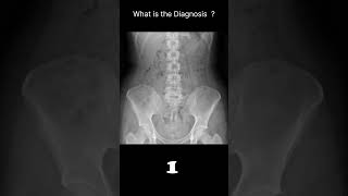 Normal  with faeces Abdominal Xray  Abnormalities  Normal reference 61 radiologychannel007 [upl. by Goto]