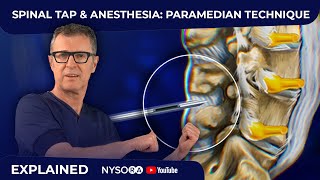 Spinal Tap  Anesthesia Paramedian Technique  Crash course with Dr Hadzic [upl. by Muhcon]