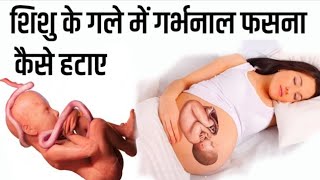 शिशु के गले में गर्भनाल फसना कैसे हटाए Umbilical Cord around baby neck in Hindi During Pregnancy [upl. by Heger991]