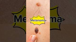 What is Melanoma  Melanoma diagnosistreatment and risk factorsmelanoma melanomaawareness cancer [upl. by Olegnalehcim]