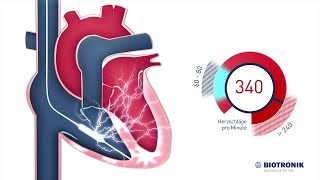 Defibrillator  ICD  Therapie Animation Medizin [upl. by Attelrahc109]