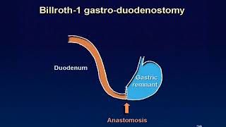 01 Billroth 1 reconstruction animation [upl. by Berry]