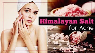 Himalayan Salt for Acne Benefits and Recipes [upl. by Yevol]