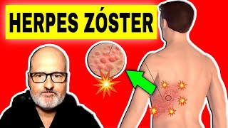 HERPES ZOSTER Culebrilla Síntomas Causas y Tratamiento 🔴 [upl. by Lazos703]