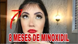 TEM COMO DIMINUIR A TESTA USANDO MINOXIDIL CONTEI PRA VCS A MINHA EXPERIÊNCIA [upl. by Hodgson]