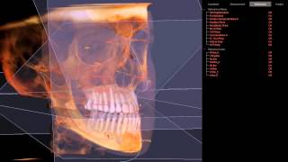 3D Cephalometric Analysis [upl. by Morissa]