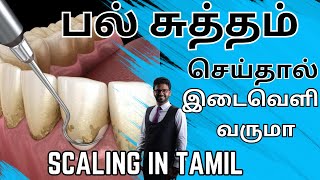 பல் சுத்தம்𝐬𝐜𝐚𝐥𝐢𝐧𝐠 செய்தால் இடைவெளி உண்டாகுமா𝐓𝐞𝐞𝐭𝐡 𝐜𝐥𝐞𝐚𝐧𝐢𝐧𝐠 𝐢𝐧 𝐭𝐚𝐦𝐢𝐥𝐬𝐜𝐚𝐥𝐢𝐧𝐠 𝐢𝐧 𝐭𝐚𝐦𝐢𝐥 [upl. by Guimar]