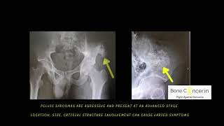 Bone Cancer TreatmentPelvis ChondrosarcomaLimb Salvage SurgeryHemipelvectomy by Dr Srimanth B S [upl. by Trebreh]