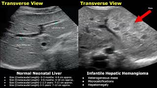 Pediatric Liver Gallbladder amp Bile Ducts Ultrasound Normal Vs Abnormal Images  Newborn amp Child USG [upl. by Mayhs]