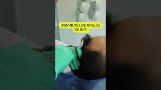 Tratamiento Anticaída para Hombres skincare cabello pelo alopecia [upl. by Vinia603]