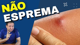 COMO TRATAR ABSCESSO TUMOR DE PUS Abscesso na coxa virilha pescoço [upl. by Neicul]