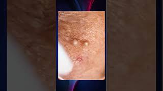 Blackheads Removal  Acne Treatment and Very Satisfying Satisfying Pimple pop blackheads [upl. by Fisch]