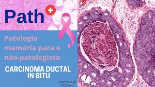 Carcinoma Ductal in situ para o não patologista  Uma atualização [upl. by Giffy]