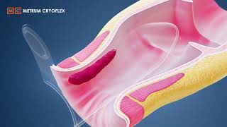 MILH procedure  Minimally Invasive Laser Hemorrhoidoplasty METRUM CRYOFLEX [upl. by Vena552]