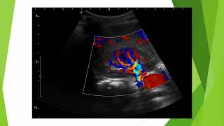 Le pic systolique précoce en doppler rénal lobulaire [upl. by Kirred]