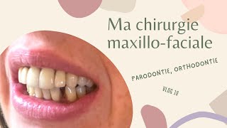 Ma chirurgie Maxillofaciale  Vlog 10  Parodontie bagues linguales témoignage [upl. by Aniram]